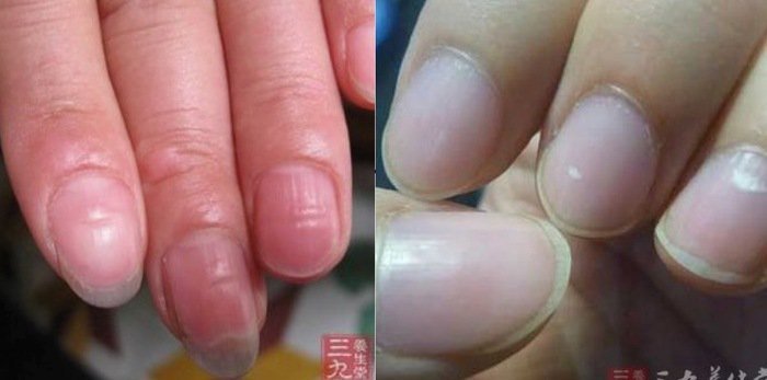 手指甲上有 白点 和 凹陷 竟然是这种身体 警告 再不改善就等著住院了 大马生活资讯网the Malaysian Recipe